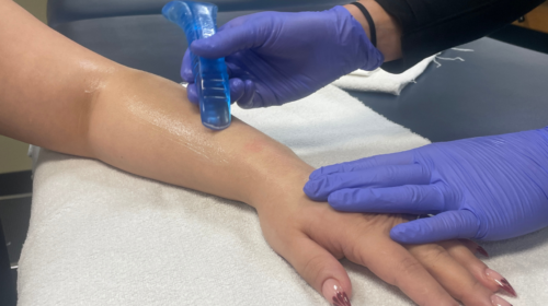Patient at PT Northwest undergoing ASTYM treatment on her forearm. ASTYM, a specialized soft tissue therapy, aims to alleviate pain and reduce swelling through targeted techniques applied to the affected area.