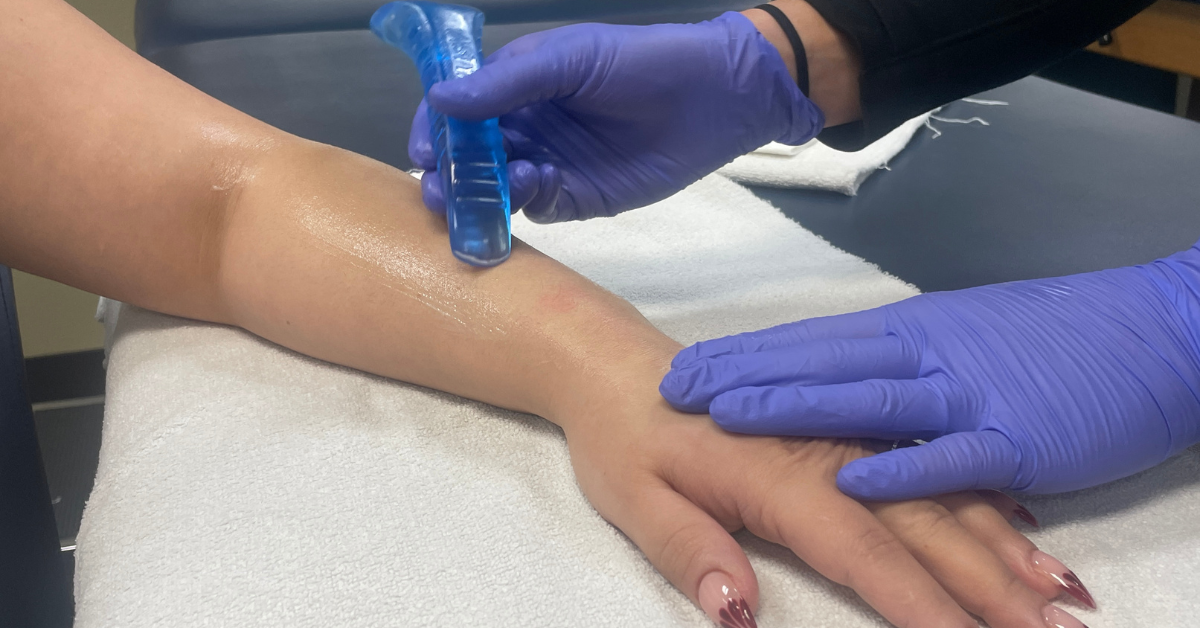 Patient at PT Northwest undergoing ASTYM treatment on her forearm. ASTYM, a specialized soft tissue therapy, aims to alleviate pain and reduce swelling through targeted techniques applied to the affected area.